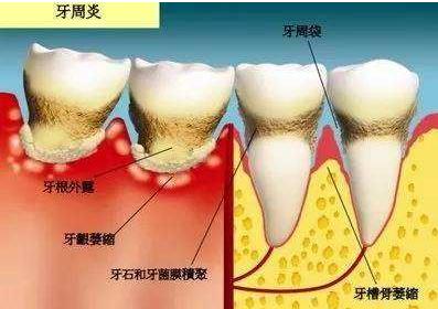 牙周炎治疗