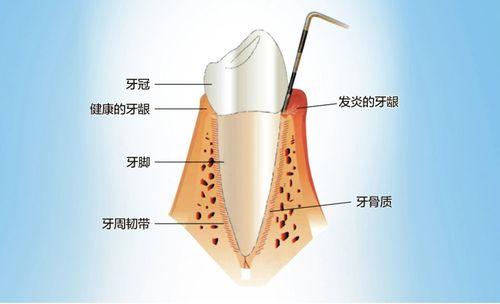 牙周炎需要注意什么